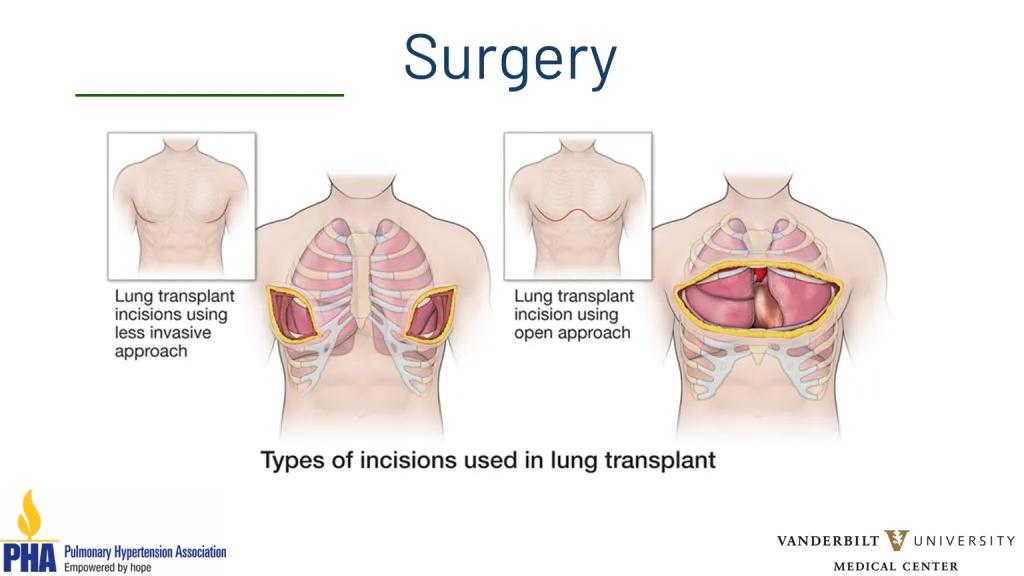 Lung transplantation webinar