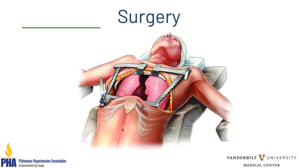 Lung transplantation webinar