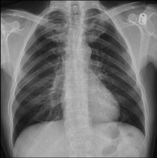 Robert Brown Chest X-ray