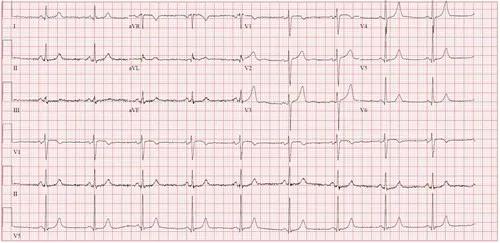 Case study Robert Brown ECG