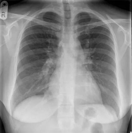Case study Yasmine Colins chest x-ray