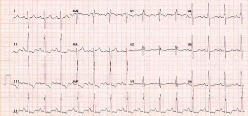Case study Yasmine Colins ECG