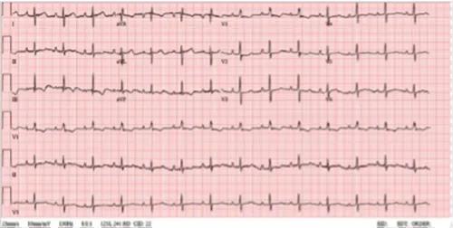 Charlotte Smith ECG