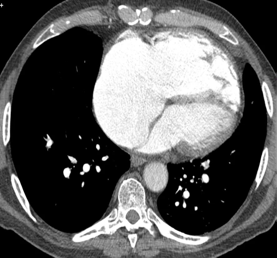Figure 1. CT pulmonary angiogram showing right heart enlargement