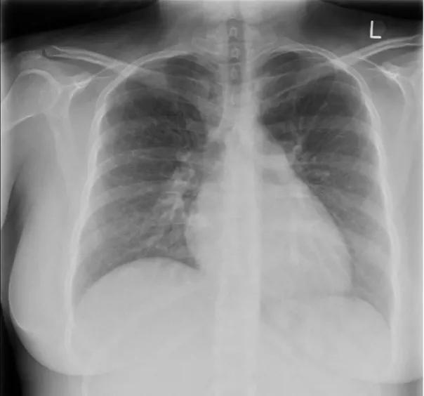 Figure 1. Typical chest X-ray in IPAH