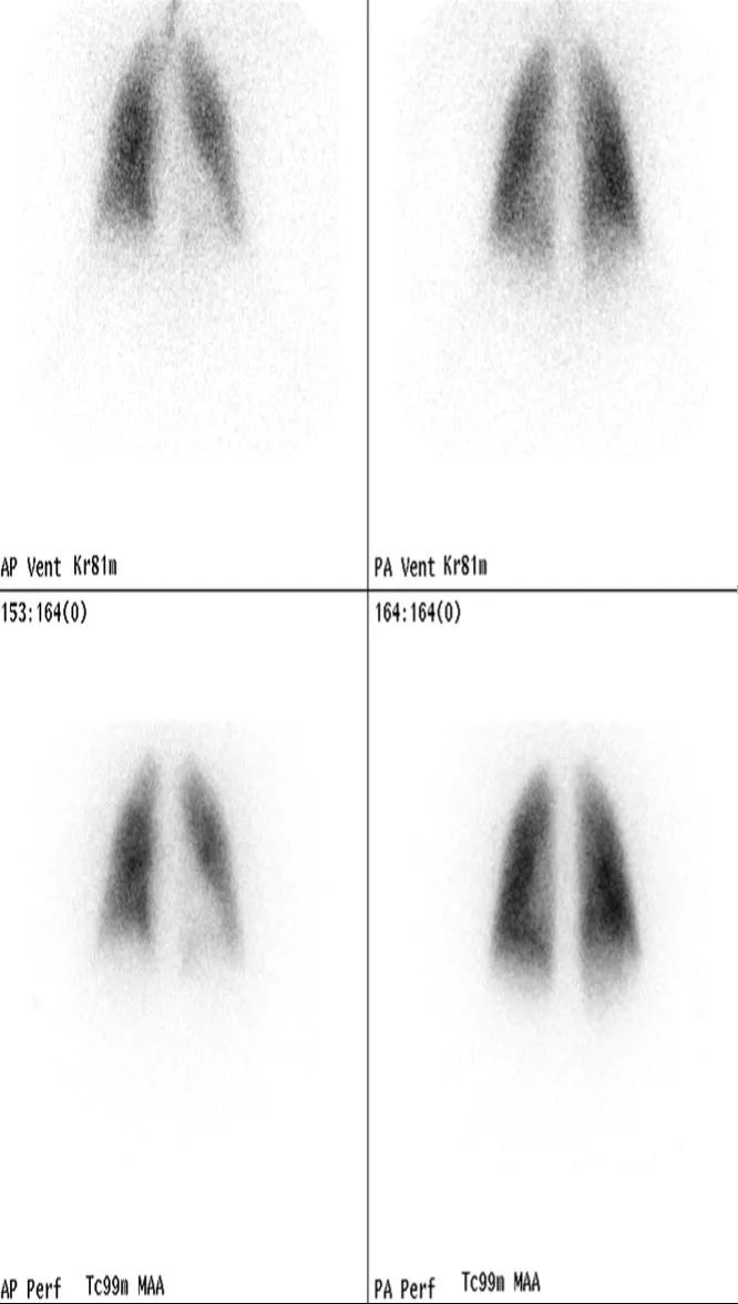 Figure 1. VQ scan in normal subject