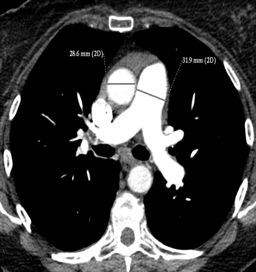 Figure 2. CTPA showing increased diameter of the pulmonary artery
