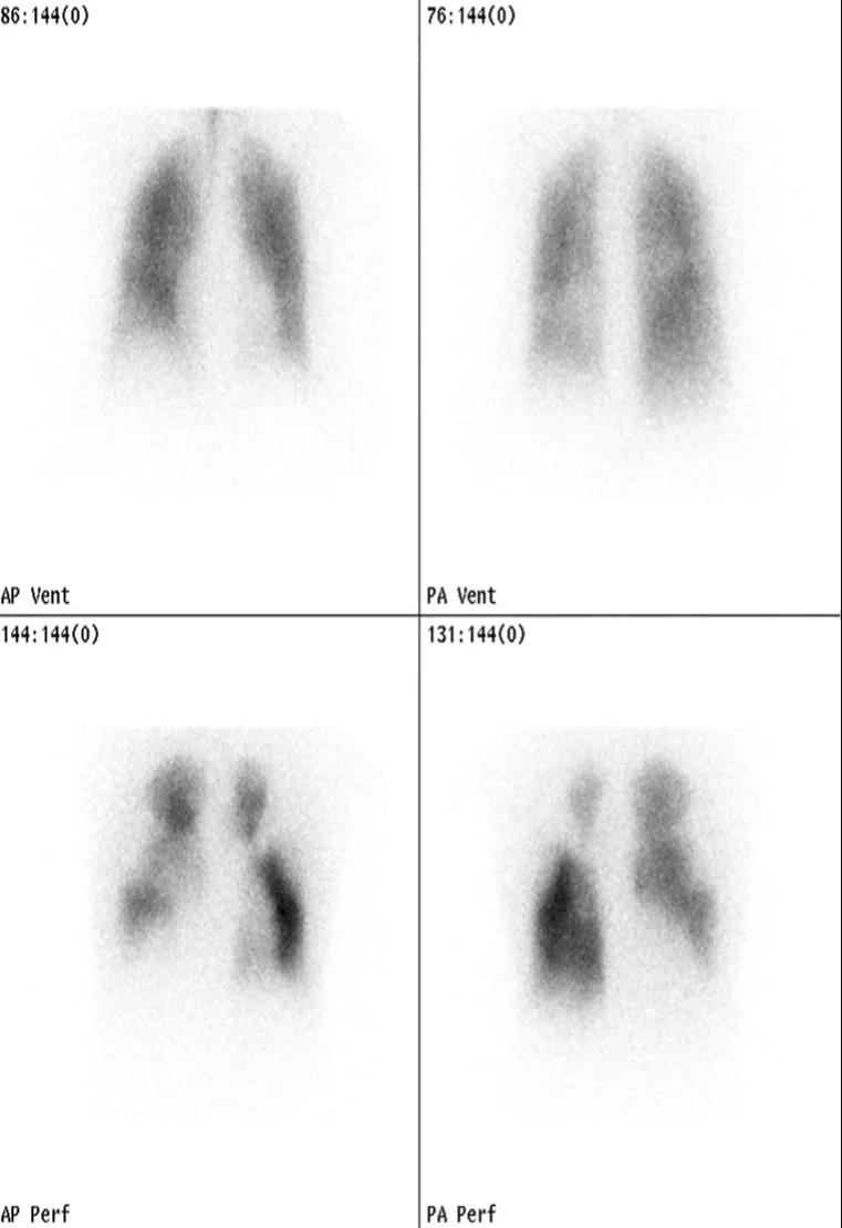 Figure 2. VQ scan in CTEPH