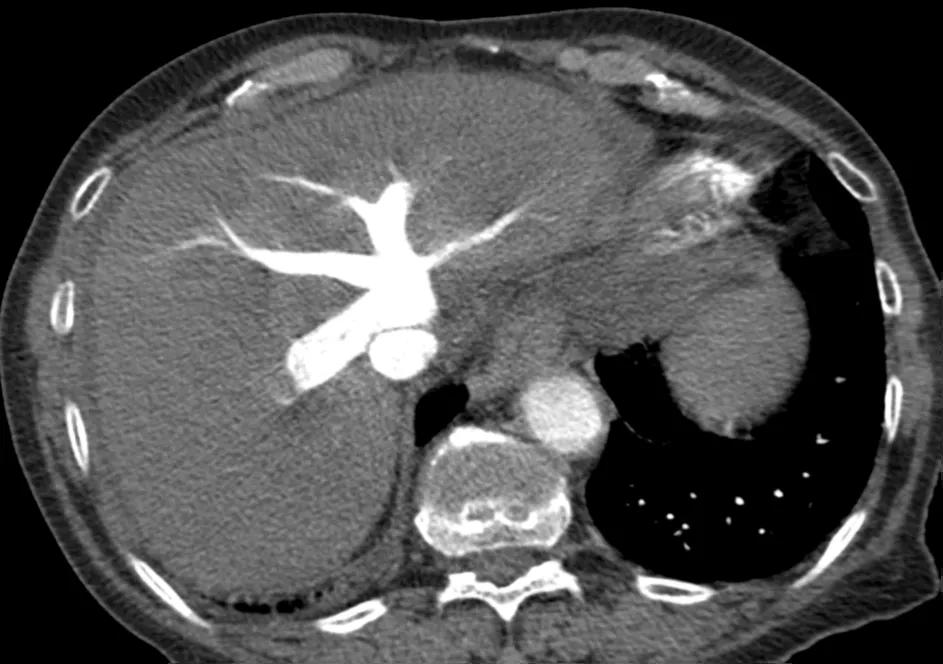 Figure 3. CTPA showing tricuspid regurgitation