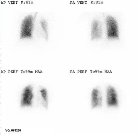 Figure 3. VQ scan in IPAH