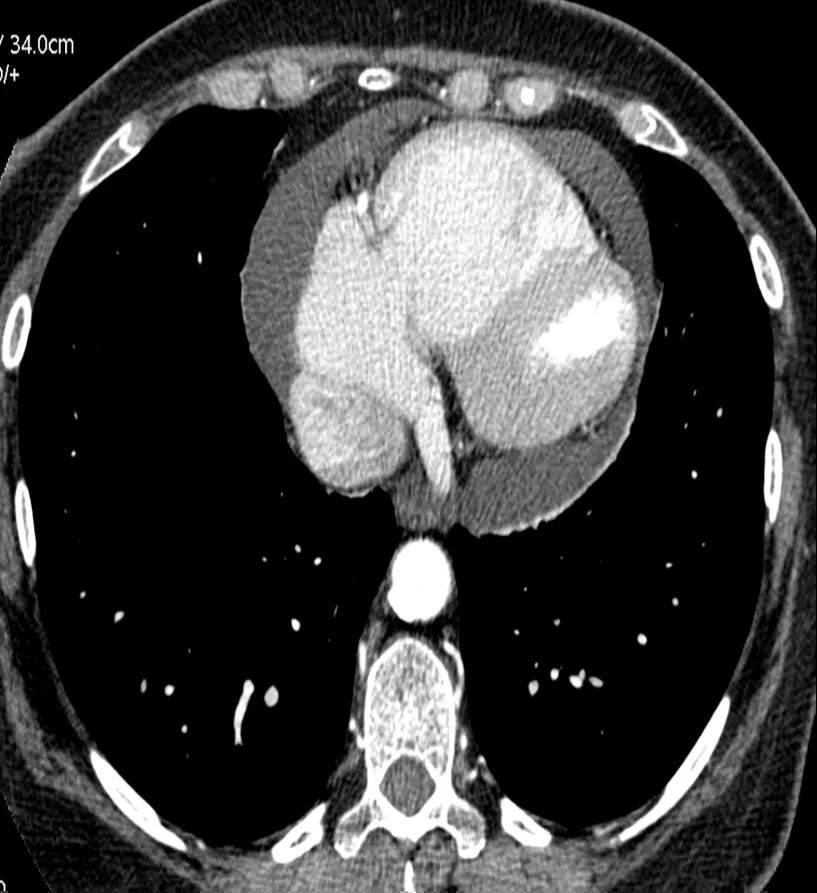 Figure 4. CTPA showing a pericardial effusion
