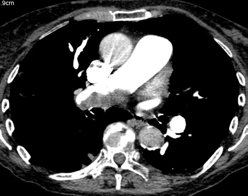 Figure 5. CTPA showing eccentric laminated thrombus