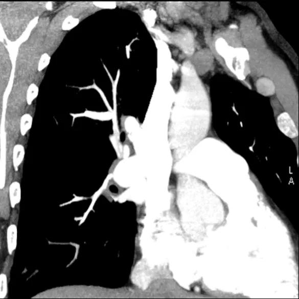 Figure 6. CTPA showing irregular vessels