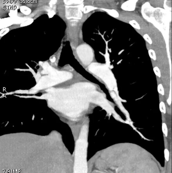 Figure 7. CTPA showing a web