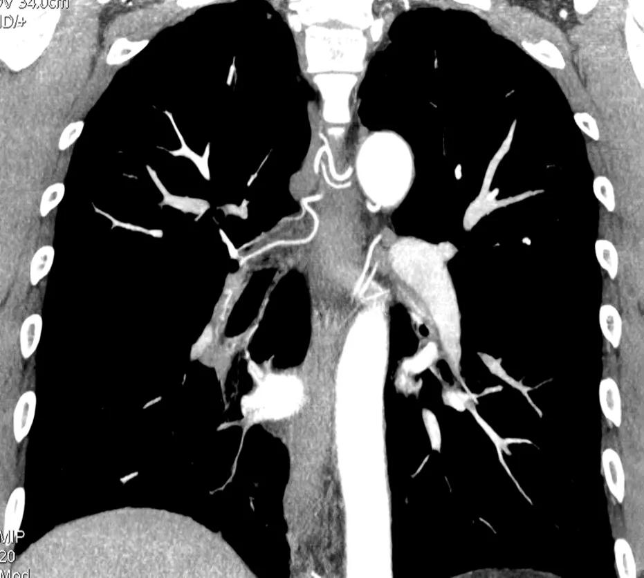 Figure 8. CTPA showing bronchial artery dilation