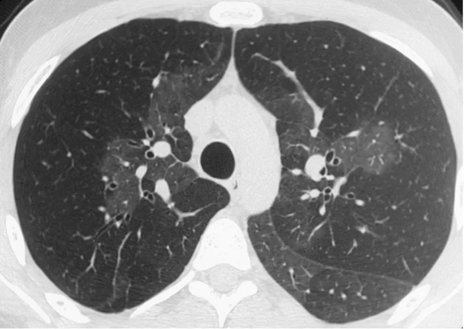 Figure 9. CT pulmonary angiogram showing mosaicism