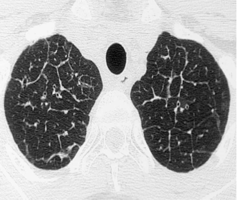 Figure 1. HRCT showing thickened interlobular septa in PVOD