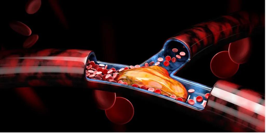 Pulmonary hypertension vs pulmonary embolism