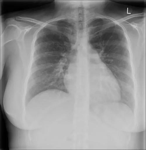 x ray